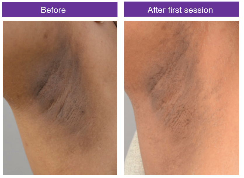 Toskani before after 1 sessions