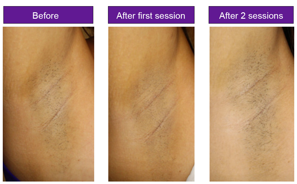 Toskani before after 2 sessions